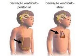 Entenda os sistemas de derivação ventrículo peritoneal: 