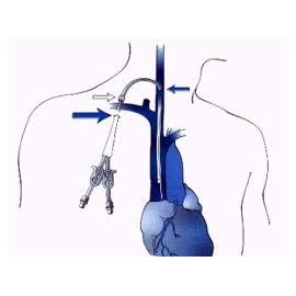 Cateteres para hemodiálise de longa duração